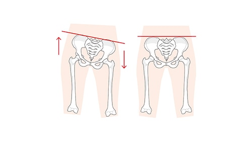 AI分析で神経圧迫箇所を特定